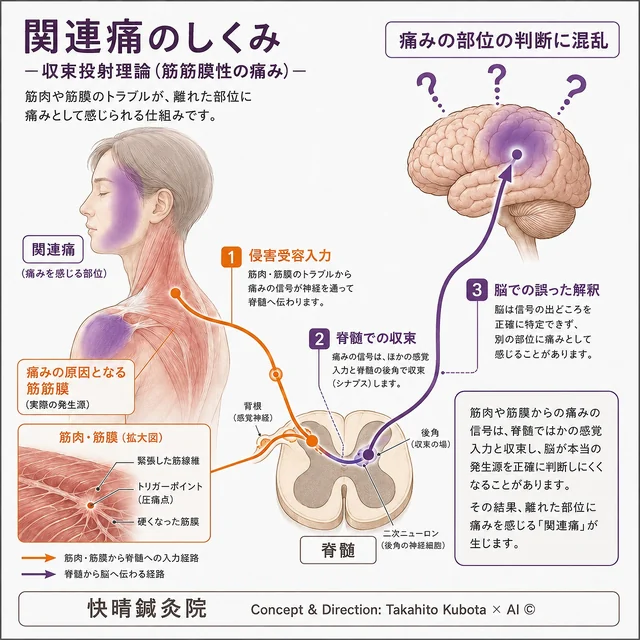 関連痛のしくみの図解｜体のあちこちの神経が背骨の中(脊髄)で同じ線に乗り入れるため、脳が痛みの発信元を取り違えて離れた場所を痛いと感じる様子を示したイラスト｜快晴鍼灸院 足柄上郡開成町