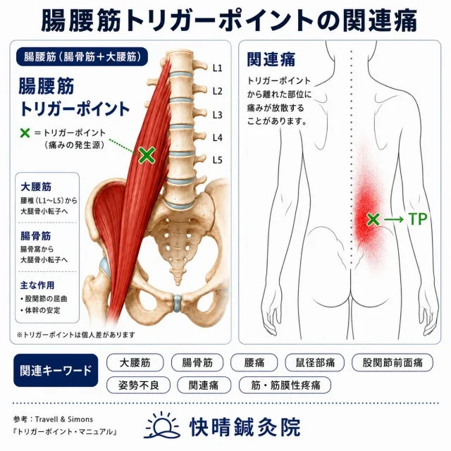 腸腰筋トリガーポイントと慢性腰痛の関連痛分布