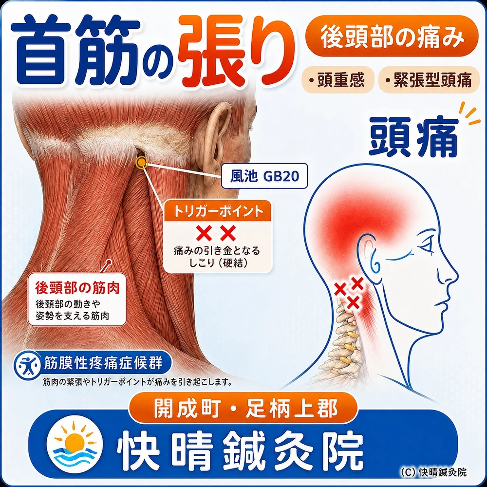 首筋の張り・首こり・首の痛みの解説図 ― 後頭部の筋肉にできるトリガーポイント（硬結）と風池(GB20)の位置、後頭部からこめかみへ広がる関連痛・頭重感・緊張型頭痛｜足柄上郡開成町の鍼灸・マッサージ・整体 快晴鍼灸院