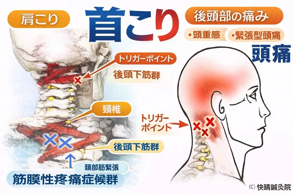 首こり・肩こりと後頭下筋群のトリガーポイントによる関連痛
