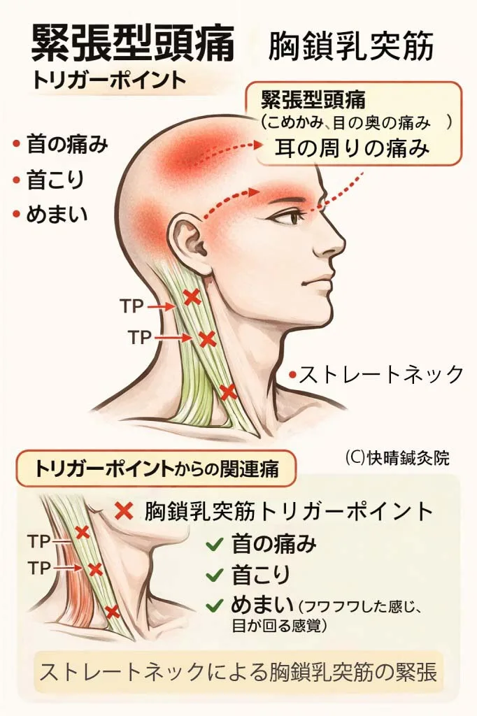 胸鎖乳突筋トリガーポイントからこめかみ・耳周り・目の奥へ放散する緊張型頭痛の関連痛分布図 ― ストレートネックと首こりが原因の頭部関連痛｜足柄上郡開成町 快晴鍼灸院