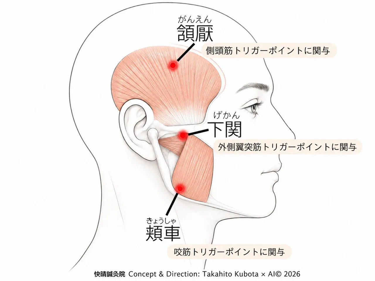 顎関節症・食いしばりに関わる側頭筋・外側翼突筋・咬筋と、東洋医学の経穴である頷厭・下関・頬車の位置関係を重ねた施術説明用イメージ図｜開成町の鍼灸マッサージ・快晴鍼灸院