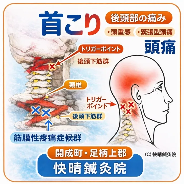 当院の得意症状 ― 首こりから起こる後頭部の痛み・頭重感・緊張型頭痛を示した解説図｜後頭下筋群のトリガーポイントと筋膜性疼痛症候群、頸椎まわりから頭へ広がる関連痛の模式図｜神奈川県足柄上郡開成町・小田急開成駅西口から徒歩4分の鍼灸・マッサージ・整体院 快晴鍼灸院