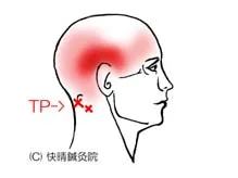 後頭下筋群の関連痛と緊張型頭痛｜首こり｜開成町 快晴鍼灸院