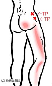 坐骨神経痛には様々な原因があります。豊富な経験を持つ快晴鍼灸院 坐骨神経痛と紛らわしい筋膜痛と関連痛、的確な施術のできる鍼灸マッサージ・快晴鍼灸院